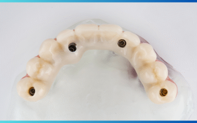 Implantologia moderna: dal trauma alla libertà di mangiare serenamente
